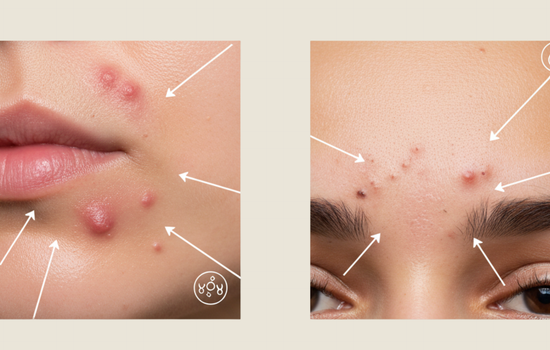 Understanding the Connection Between Hormones and Breakouts